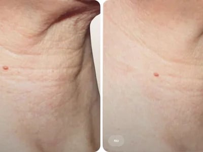 Straffere Haut mit profhilo hals bei MorySkin