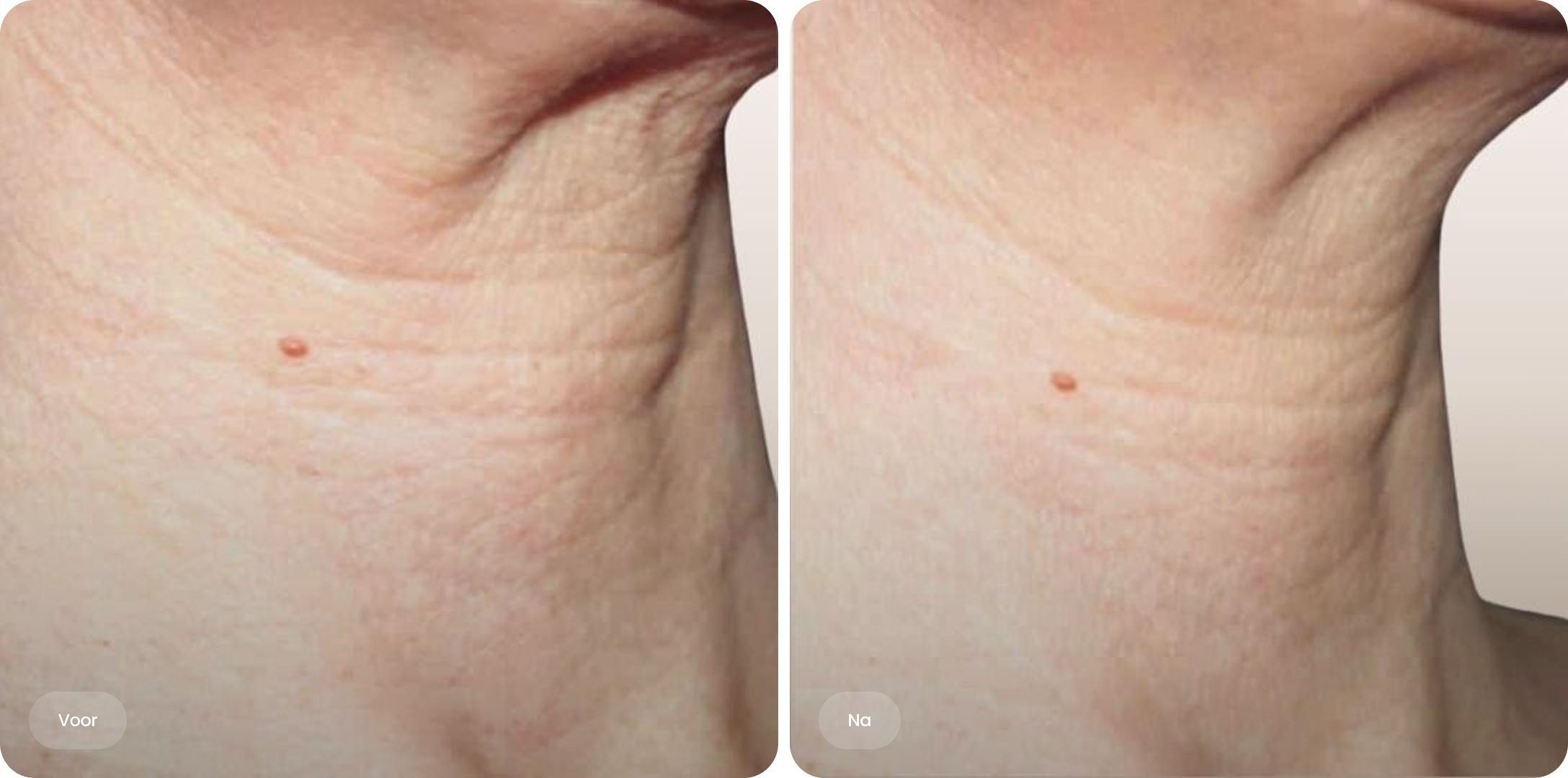 Straffere Haut mit profhilo hals bei MorySkin